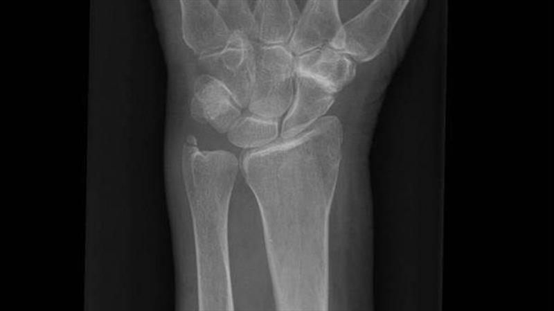 Jude's left wrist shows the many small bones - photo © Jack and Jude