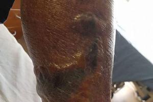 SA Health said while the bacteria is common, infection is not — especially extreme cases like this one. photo copyright Kylie Andrew-Komar taken at  and featuring the  class